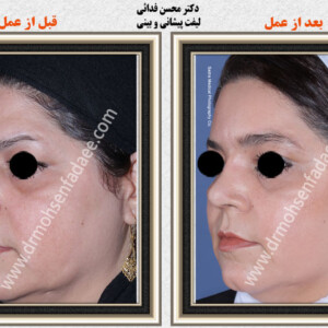 لیفت صورت لیفت صورت