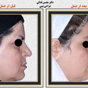 لیفت صورت لیفت صورت