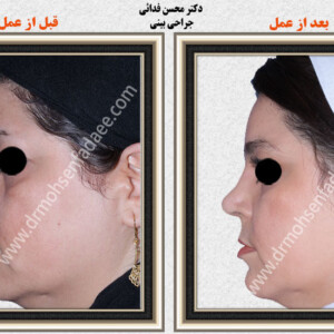 لیفت صورت لیفت صورت