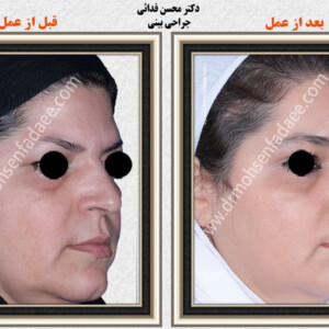 لیفت صورت لیفت صورت