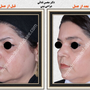 لیفت صورت لیفت صورت