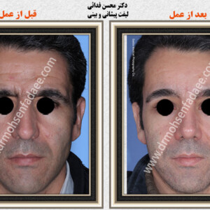 لیفت صورت لیفت صورت