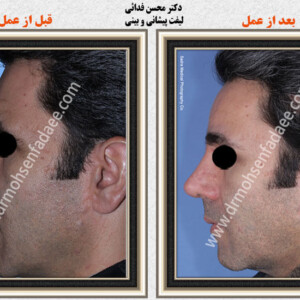 لیفت صورت لیفت صورت