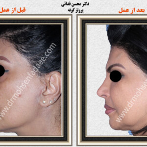 پروتز های صورت پروتز های صورت