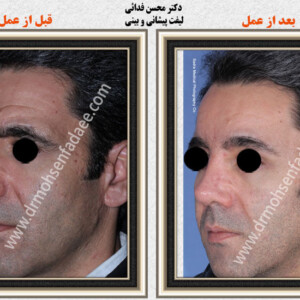 لیفت صورت لیفت صورت