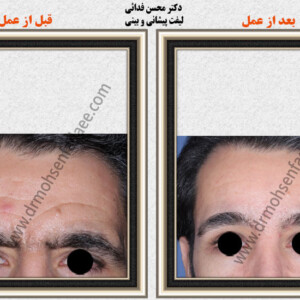 لیفت صورت لیفت صورت