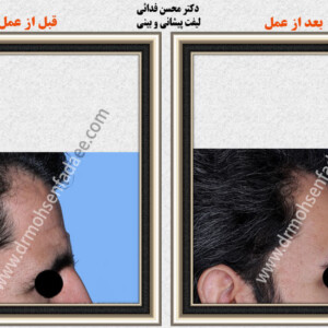 لیفت صورت لیفت صورت