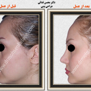 جراحی بینی جراحی بینی
