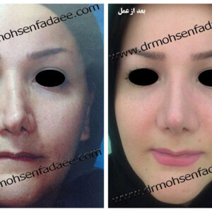 جراحی بینی جراحی بینی