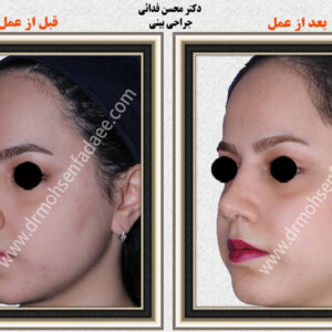 جراحی بینی جراحی بینی