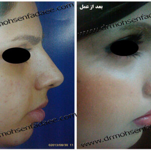 جراحی بینی جراحی بینی