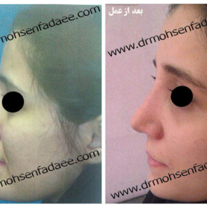 جراحی بینی جراحی بینی