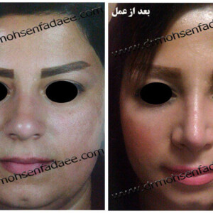 جراحی بینی جراحی بینی