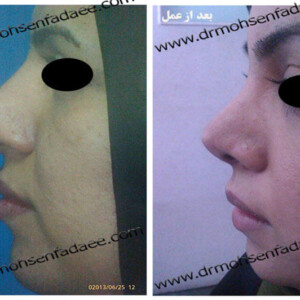 جراحی بینی جراحی بینی