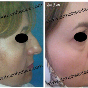 جراحی بینی جراحی بینی