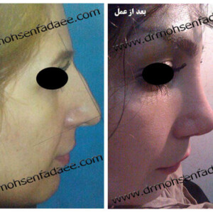 جراحی بینی جراحی بینی
