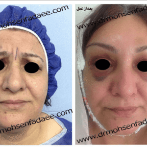 لیفت صورت لیفت صورت