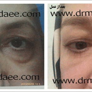 لیفت صورت لیفت صورت