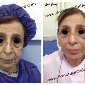 لیفت صورت لیفت صورت