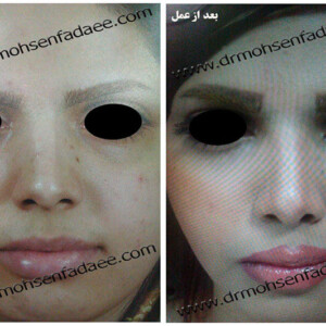 جراحی بینی جراحی بینی