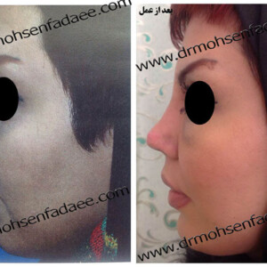 جراحی بینی جراحی بینی