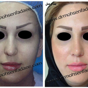 جراحی بینی جراحی بینی