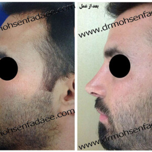 جراحی بینی جراحی بینی