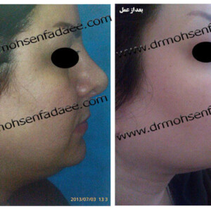 لیپوماتیک لیپوماتیک