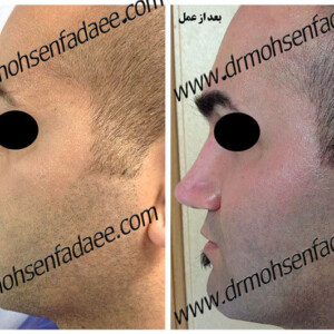 جراحی بینی جراحی بینی