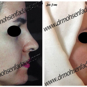 جراحی بینی جراحی بینی