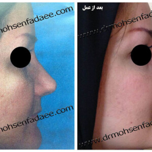 جراحی بینی جراحی بینی