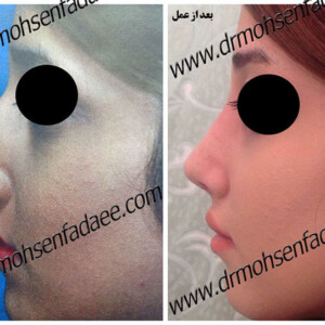 جراحی بینی جراحی بینی