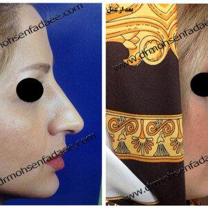 جراحی بینی جراحی بینی