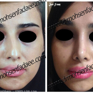 جراحی بینی جراحی بینی