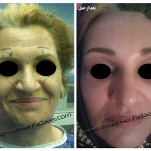 لیفت صورت لیفت صورت