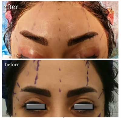 Brow Bone Reduction / Brow Bone Shaving | دکتر محسن فدایی| فوق تخصص ...