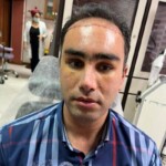 لیفت صورت - جراحی بینی