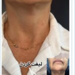 لیفت گردن با دستگاه رنووین