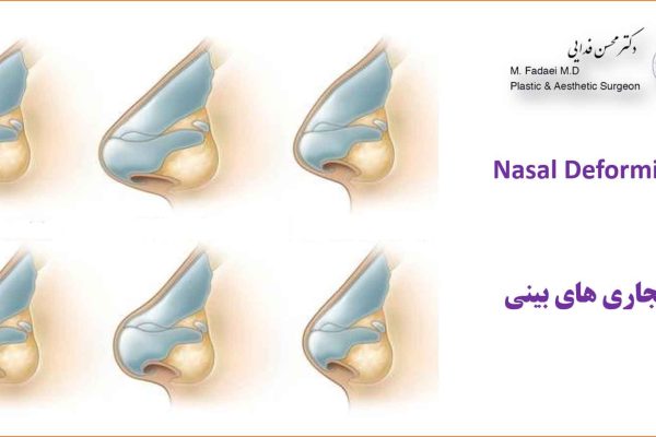 انواع ناهنجاری های بینی