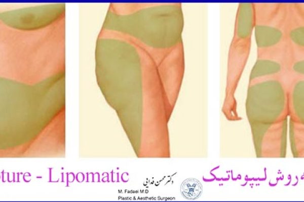 پیکرتراشی به روش لیپوماتیک