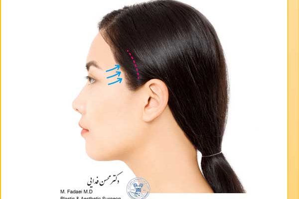 لیفت شقیقه و ابرو - Temple & Brow Lift