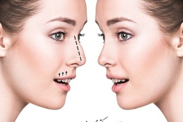 اصلاح عیوب بینی با تزریق فیلر - روش غیرجراحی رینوپلاستی بینی