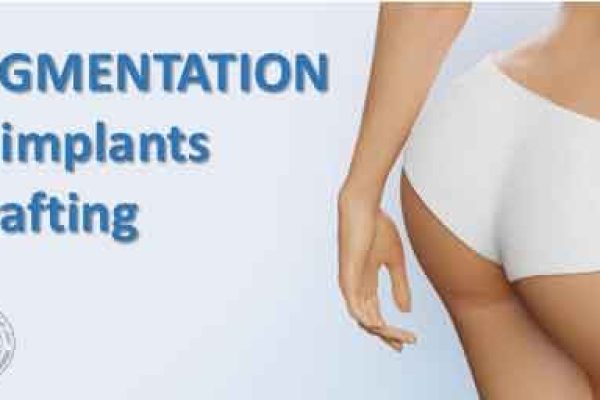 BUTTOCK AUGMENTATION : fat grafting and buttock implants