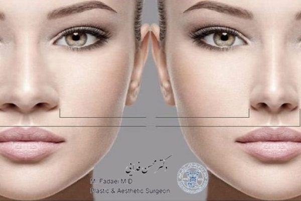 عمل بینی گوشتی