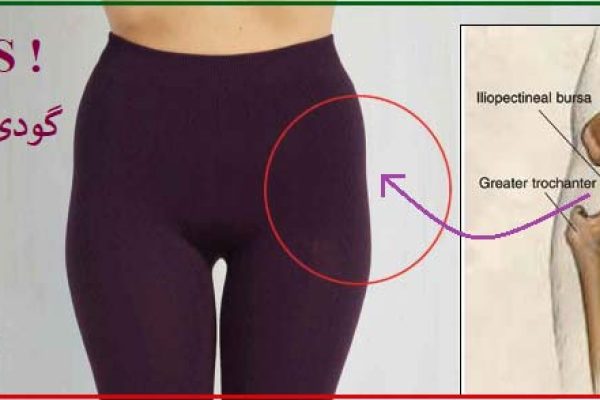 رفع گودی کنار باسن با تزریق چربی - Fat Transfer to Hip Dips - إصلاح الغمازة بجانب الأرداف