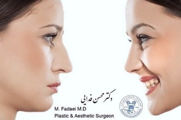 Open Rhinoplasty