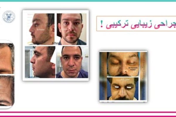 روش های ابدومینوپلاستی