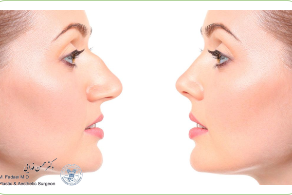 جراحی رینوپلاستی