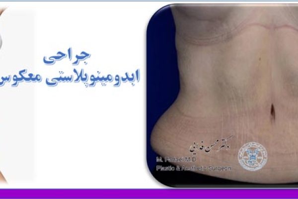ابدومینوپلاستی معکوس