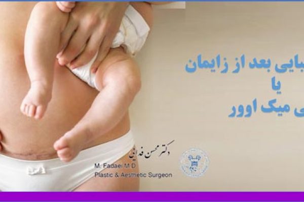 جراحی زیبایی بعد از بارداری و ایمان